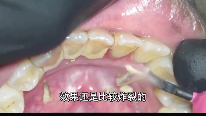 最新去牙垢科普指南，實用方法與建議